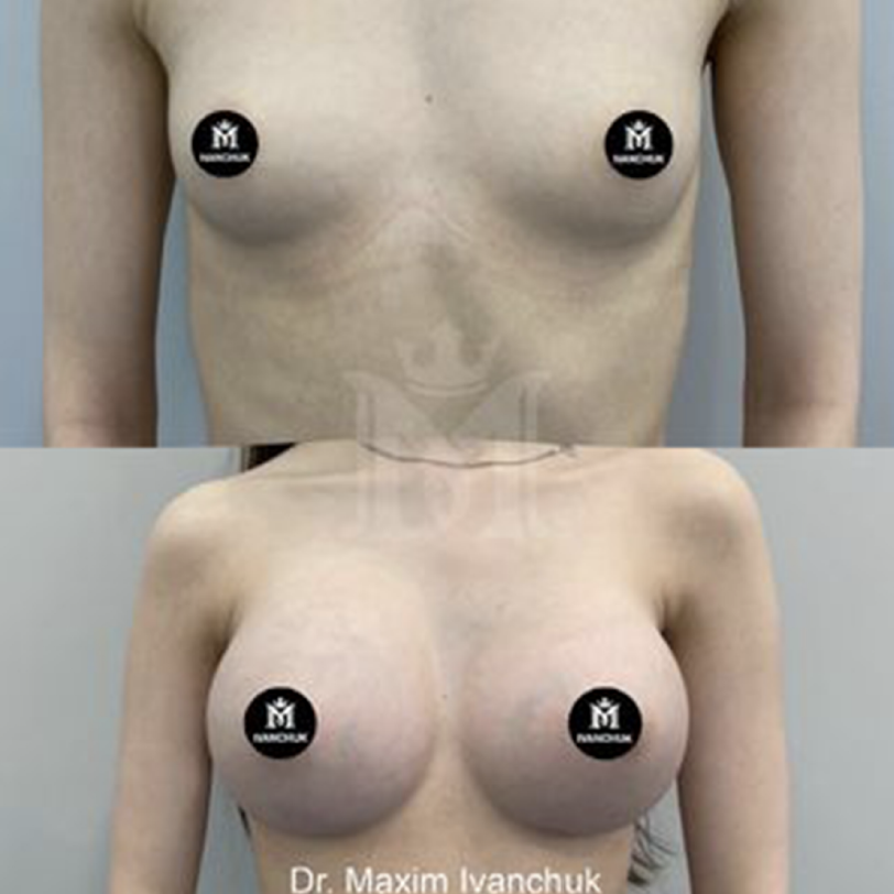 Mammoplasty