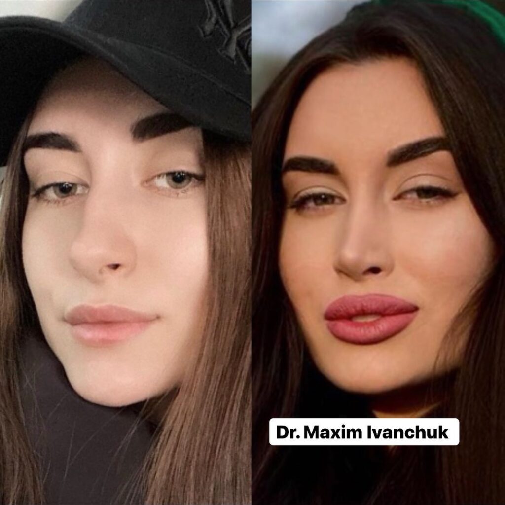 rhinoplasty cost in dubai