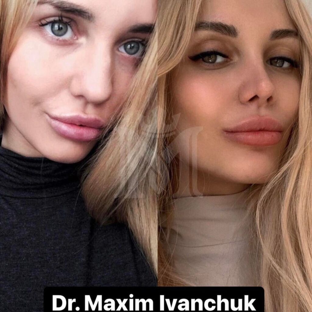 rhinoplasty cost in dubai