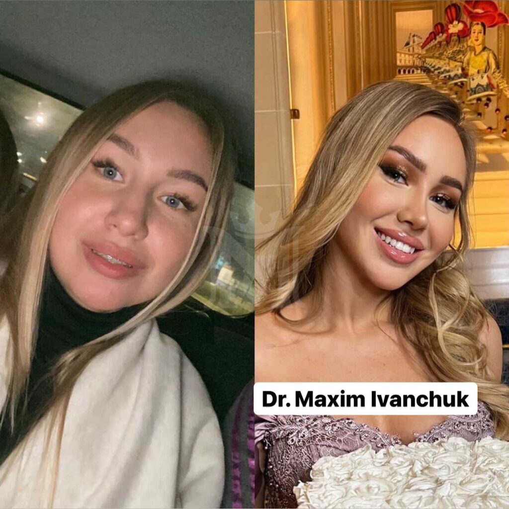rhinoplasty dubai