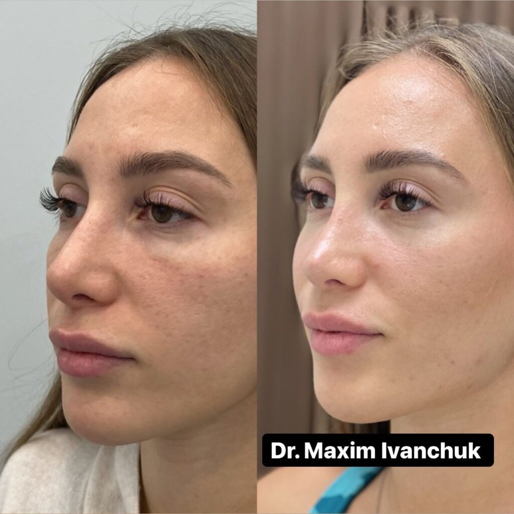 rhinoplasty in dubai